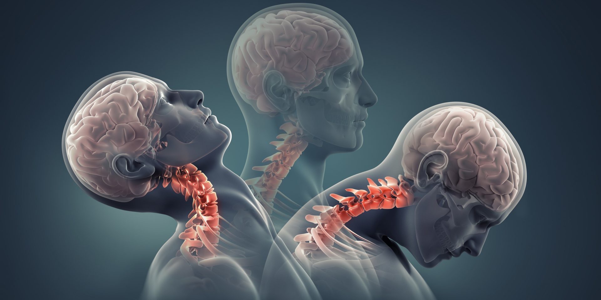 Chiropractic for Car Accidents