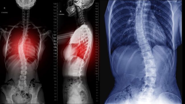 Chiropractic for Scoliosis